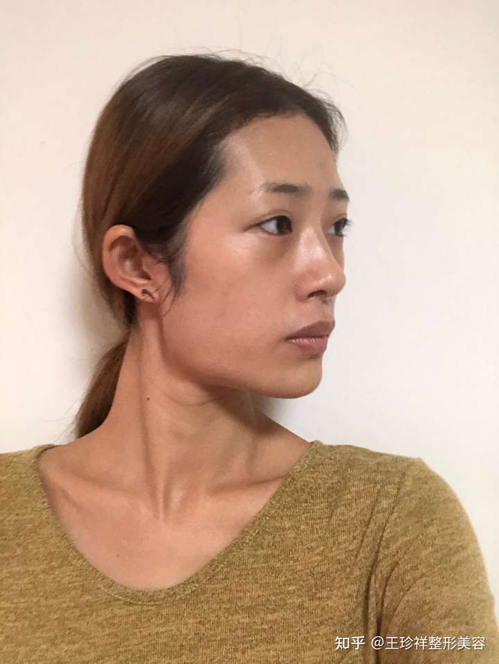 下颚角这样是不是基本方脸没救了?