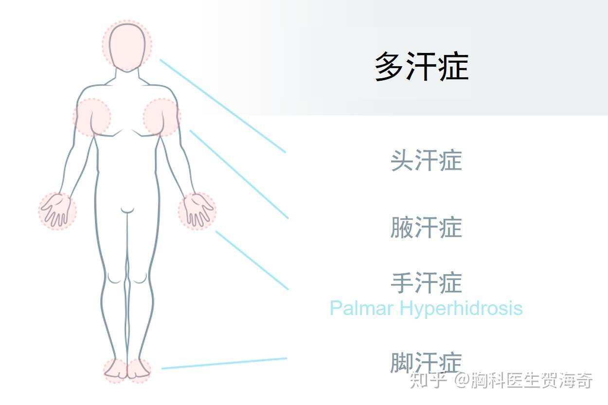 手汗太烦人了 手汗症 多汗症人群究竟有多少 知乎