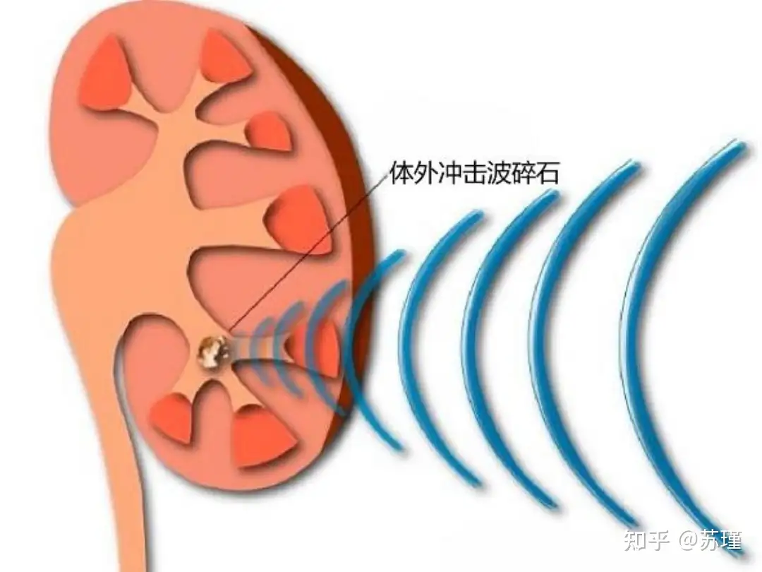 为什么现在公立医院不再推荐体外碎石了？更多的是倾向于输尿管软镜手术？