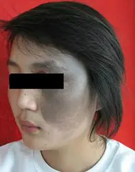 太田痣是一种色素增生性皮肤疾病,是面部胎记中很常见的一种,近年来
