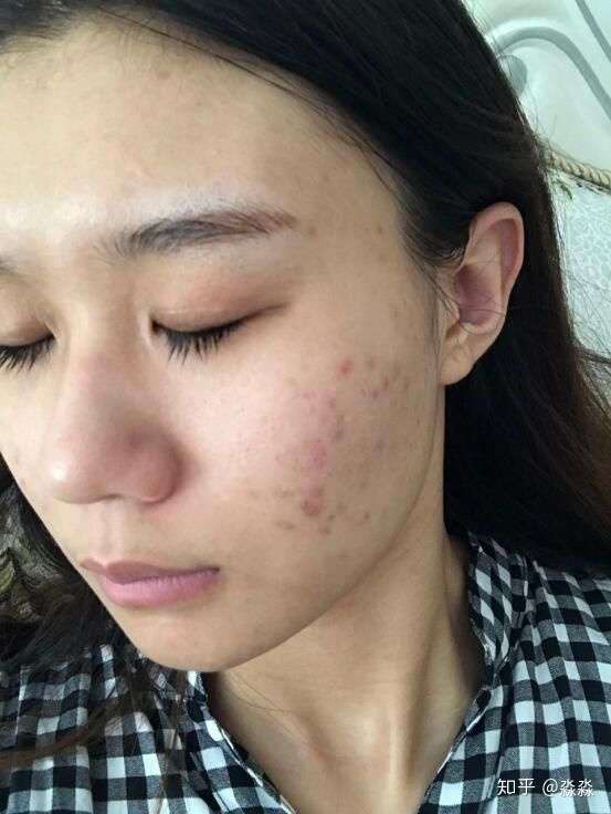 本人青春起留下的痘印,算上痘龄4年时间,2个半月治好!