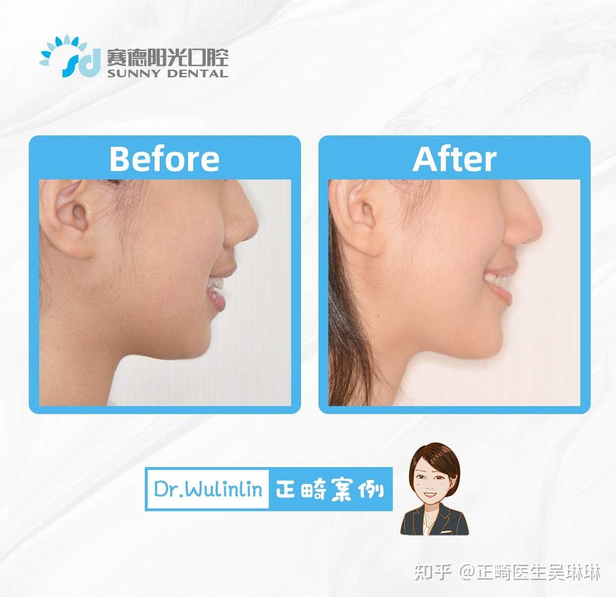 牙齿矫正送下巴 堪比整容 知乎
