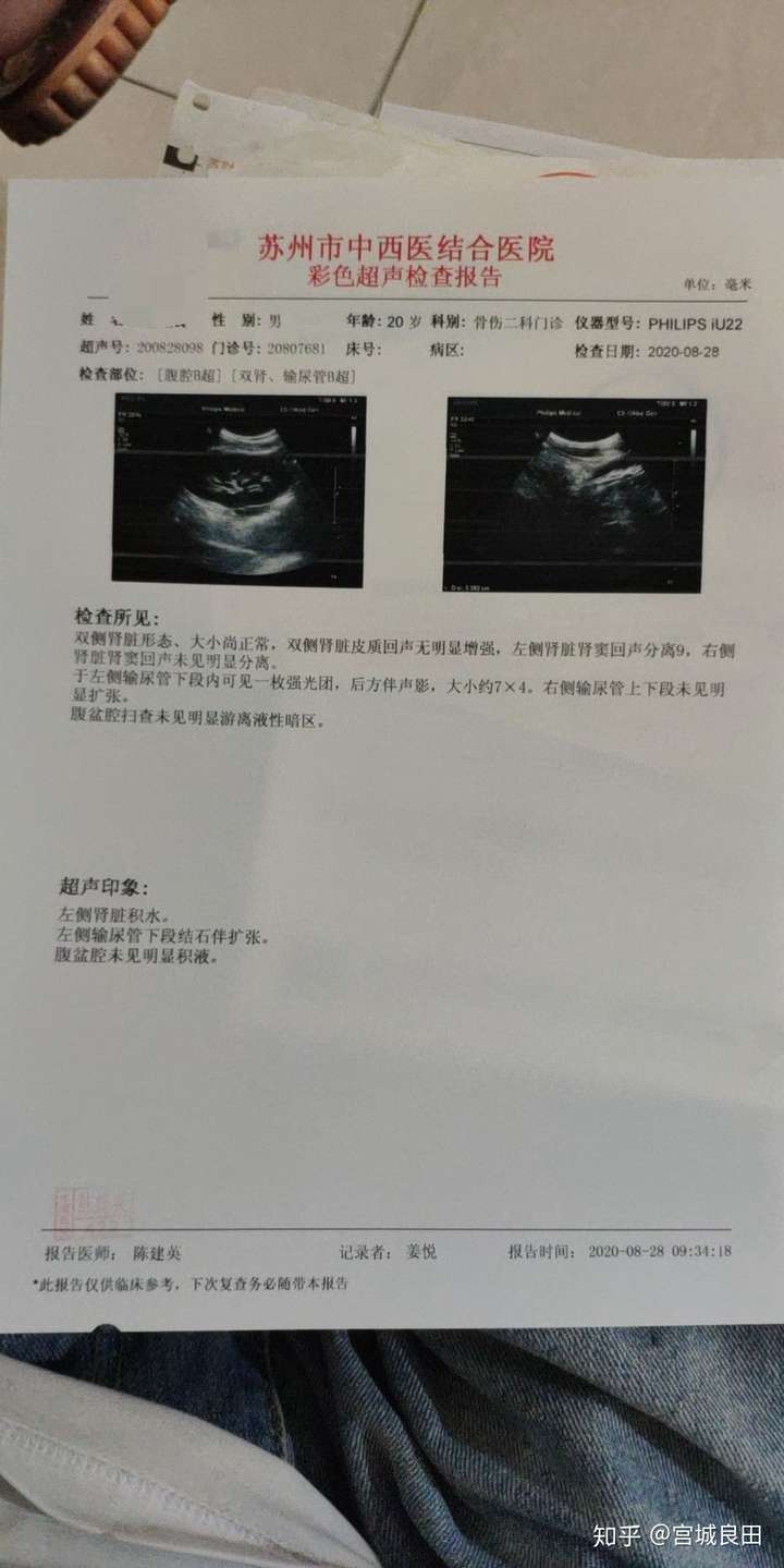 尿结石第三天求