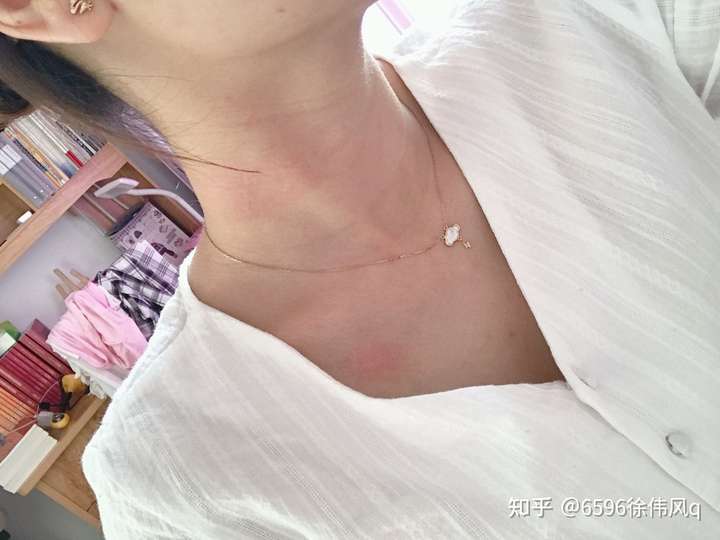 脖子上得荨麻疹