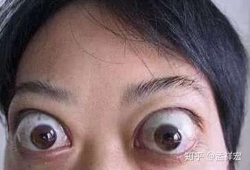 [图片]如图所示,请问各位,我这种的,是眼球突出还是眼皮脂肪厚呢,该