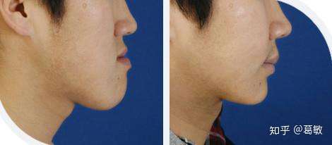 长得好丑怎么办非常自卑而且下巴歪的左右脸不一样