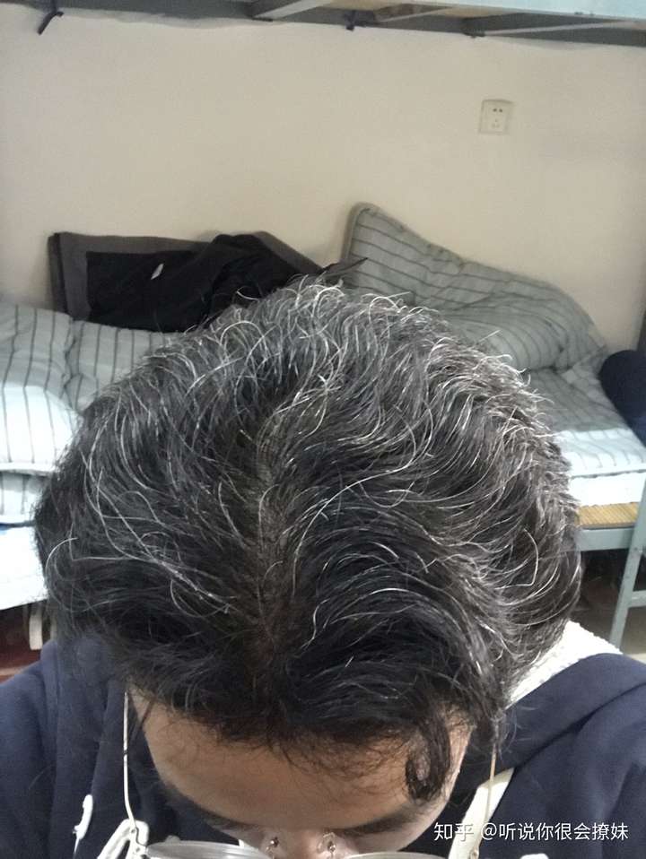 女生少白头严重,白头发一大半,很烦恼自卑,平时染发.