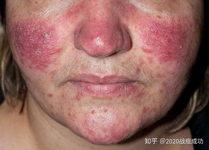 得了玫瑰痤疮的你们是怎么好的