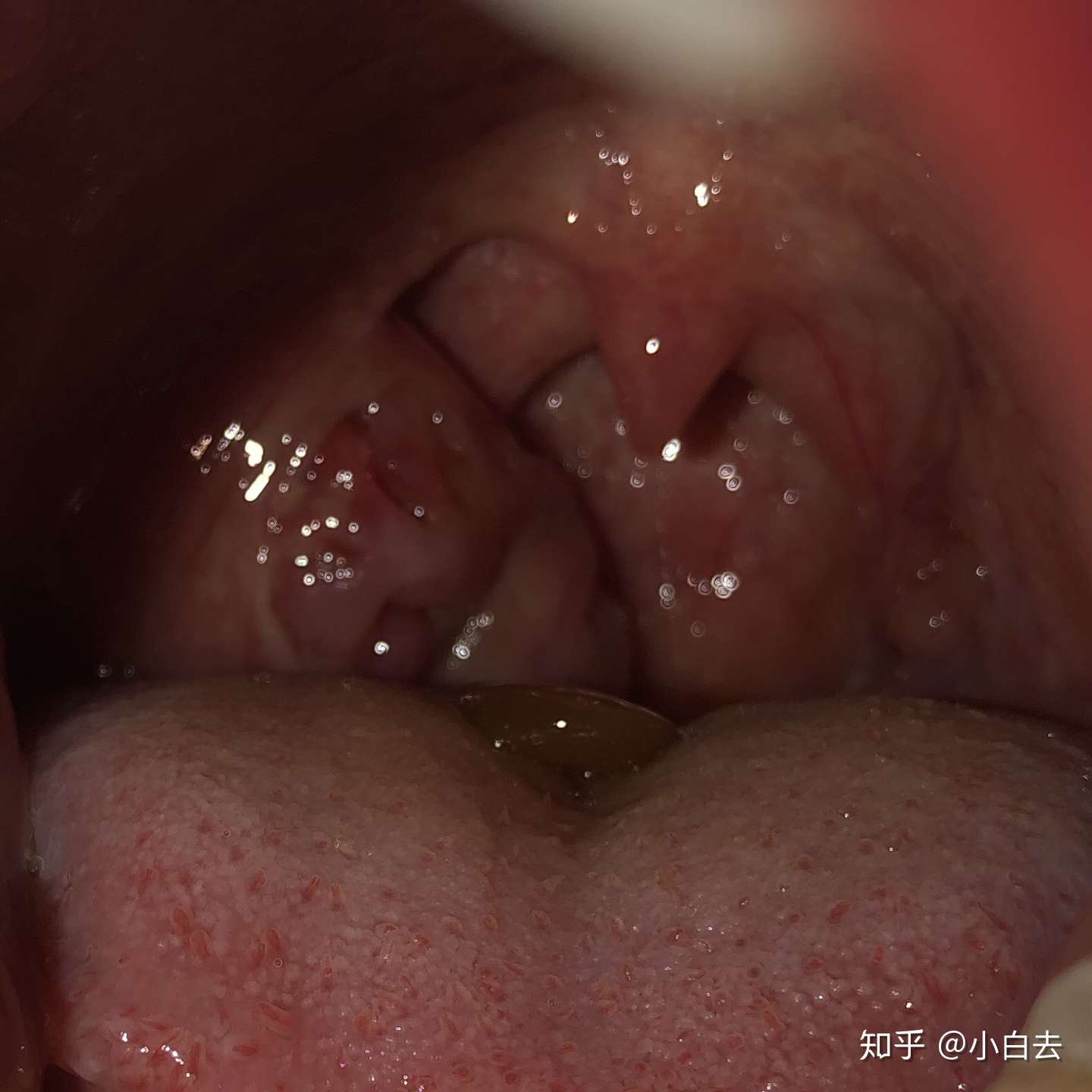 扁桃体切除手术有多可怕 知乎