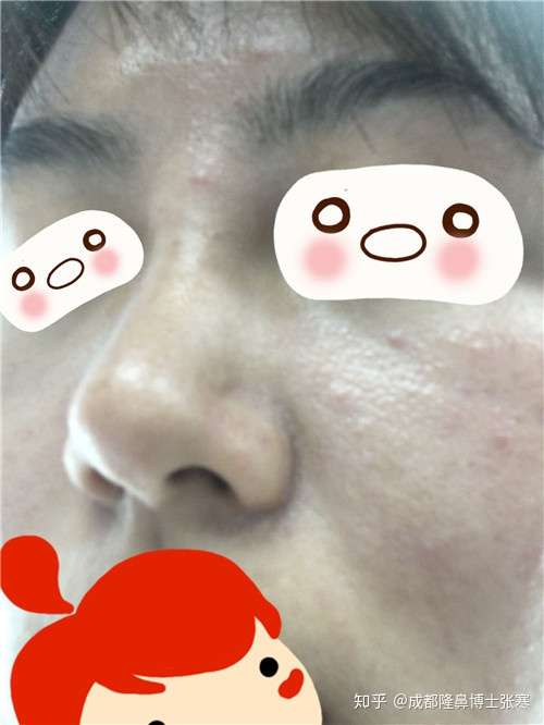 隆鼻后可以挤黑头吗 知乎
