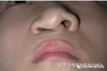 唇裂鼻子塌陷怎么修复:继发性唇裂鼻畸形