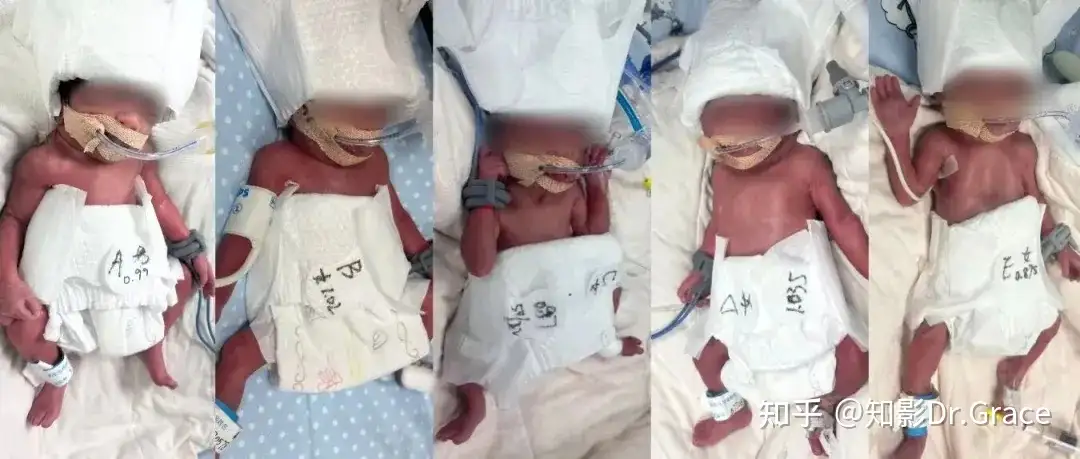 新疆一24 岁产妇诞下 5 胞胎，多胎妊娠会面临哪些挑战？哪种高危妊娠因素最危险？