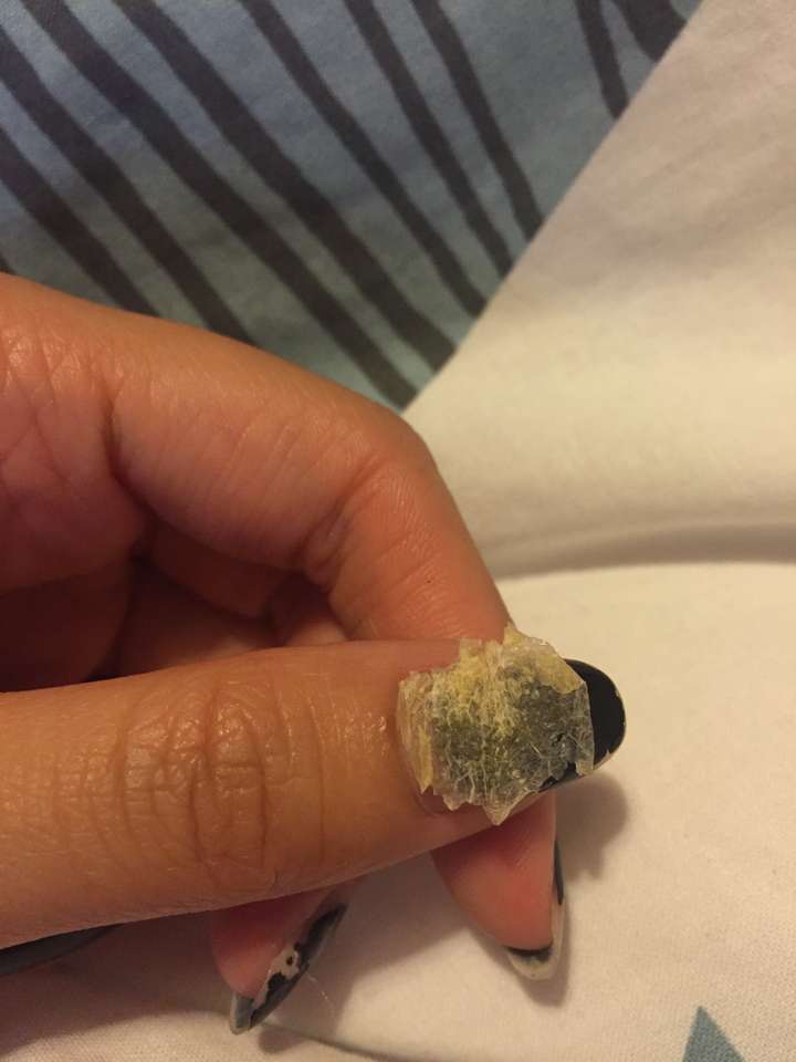 为什么我掏出来的耳屎是桶状的,就是一层薄膜粘附在耳壁上?