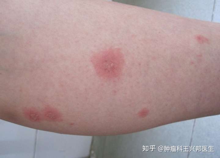 肝癌病变有没有症状