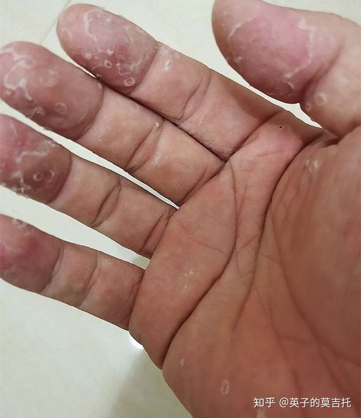 手容易脱皮,吃什么好?