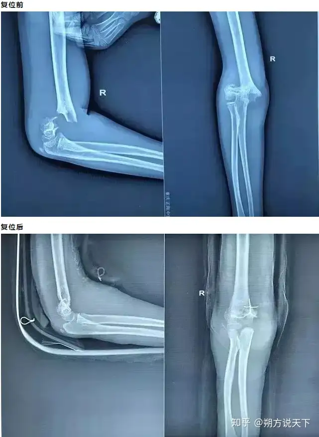 全国中医学术流派·千年传承非遗保护·重庆老字号-燕青门正骨派（重庆正刚中医骨科医院）（重庆十大中医名人） 第11张