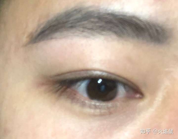 眼角有个胎记该不该告诉未婚夫?