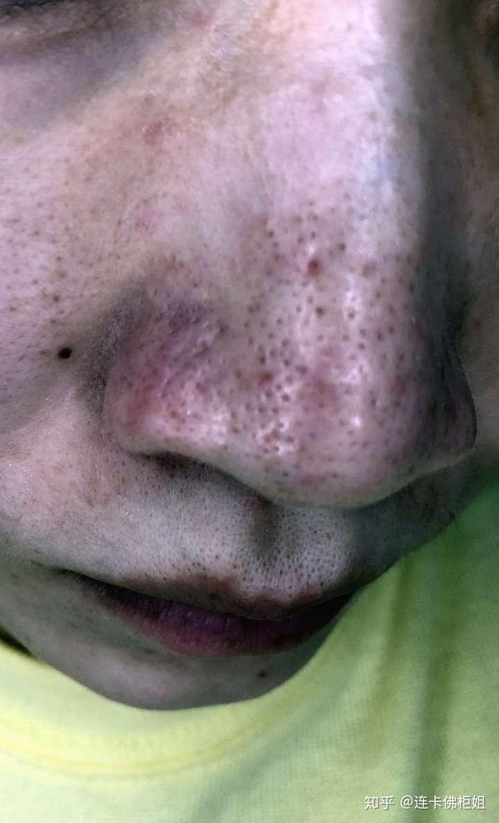 挤黑头的时候鼻子留下个红点,已经两年了,请问怎么解决?有图.