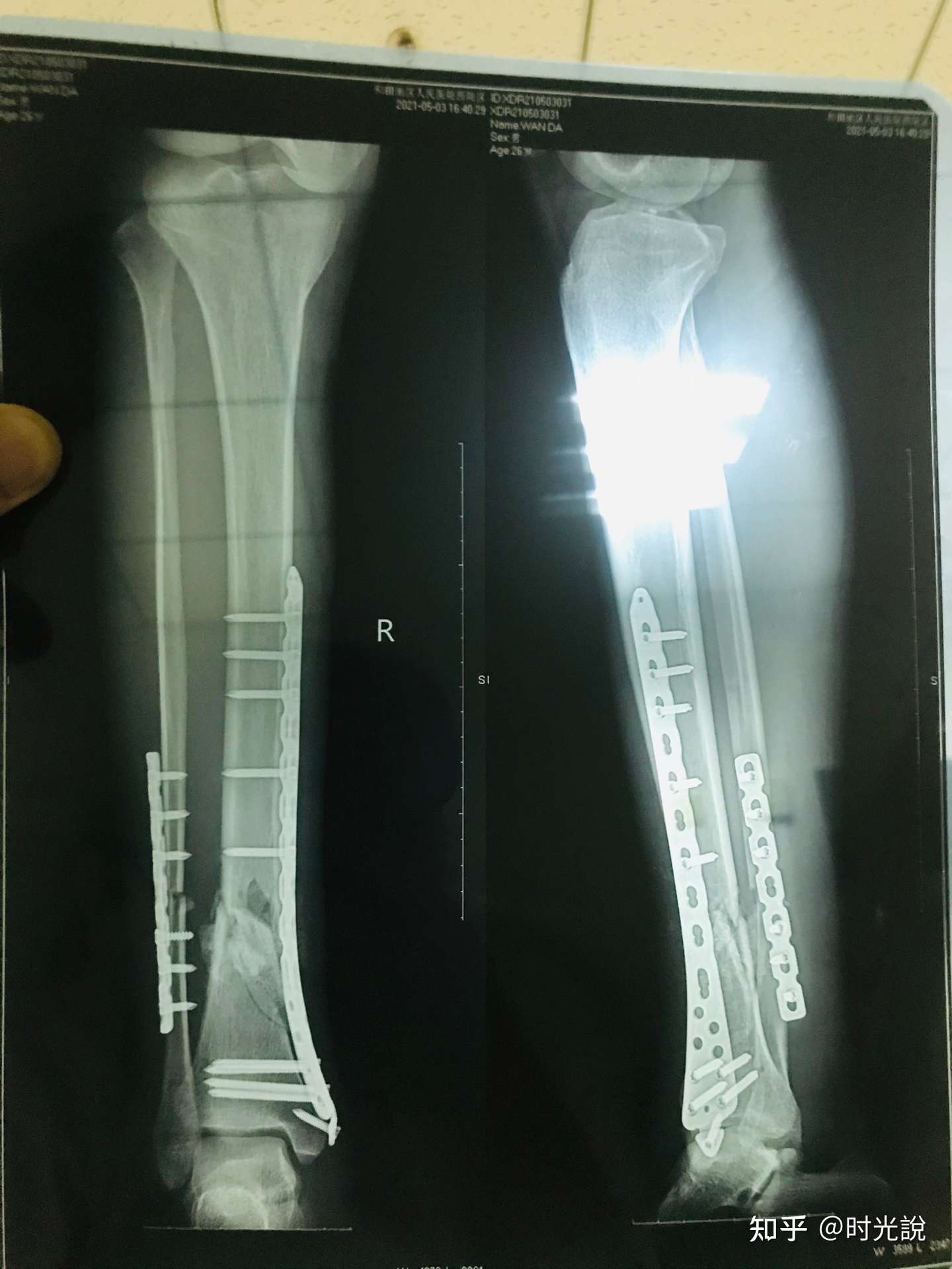 右腿小腿大小胫腓骨骨折 知乎
