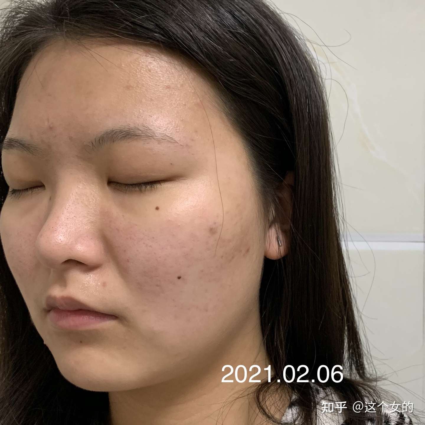 异维a酸停药半年多后复发 真正的勇士就是再吃一次 持续更新 知乎