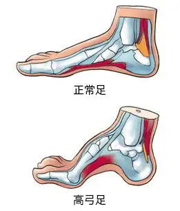 上下交叉体态lcs之平背旋后足