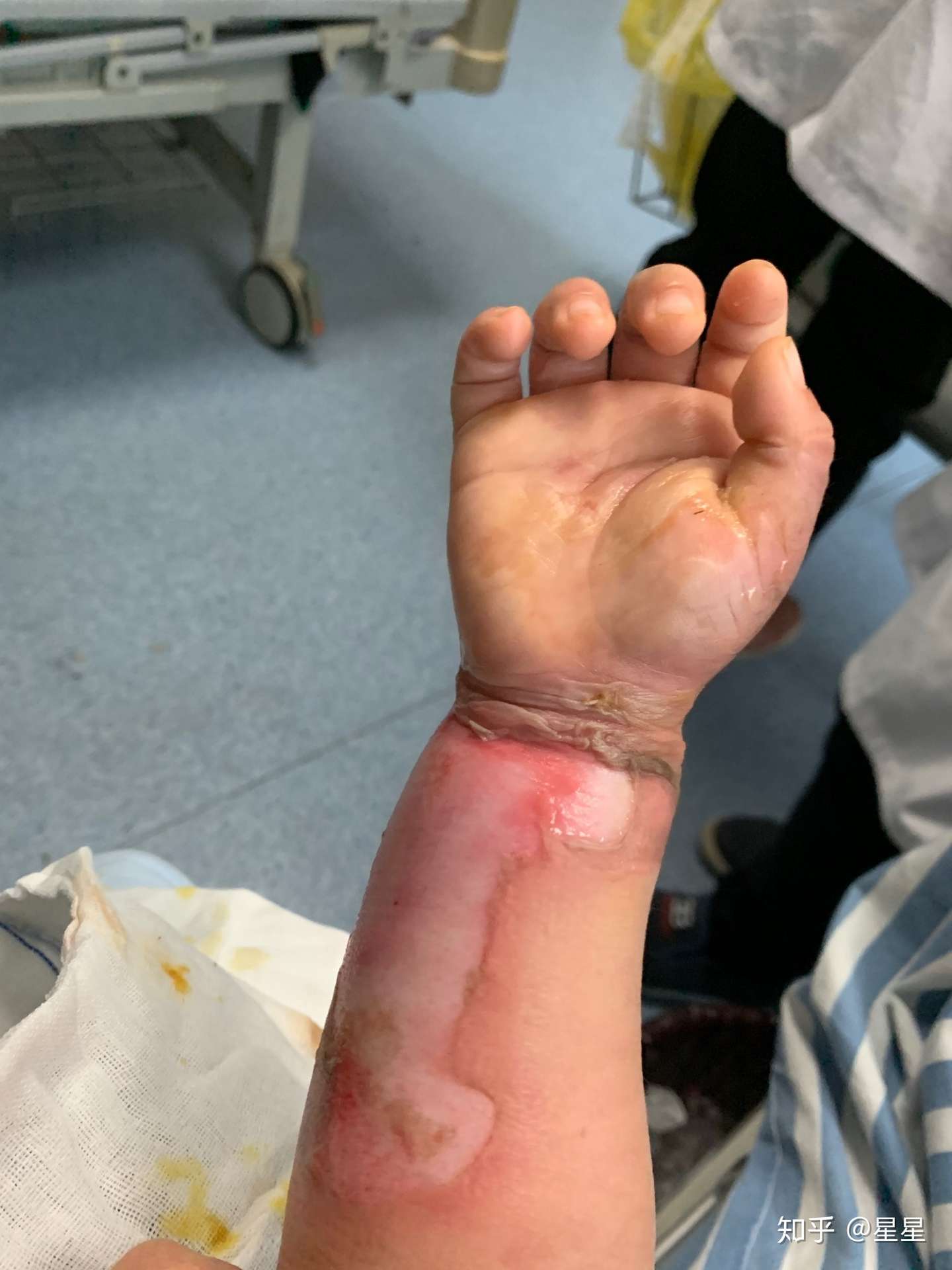 两岁宝宝深二度烫伤 会留疤吗 知乎