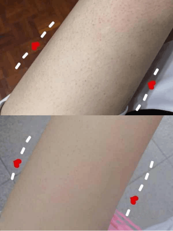 什么成分可以缓解鸡皮肤(什么成分可以缓解鸡皮肤的症状)