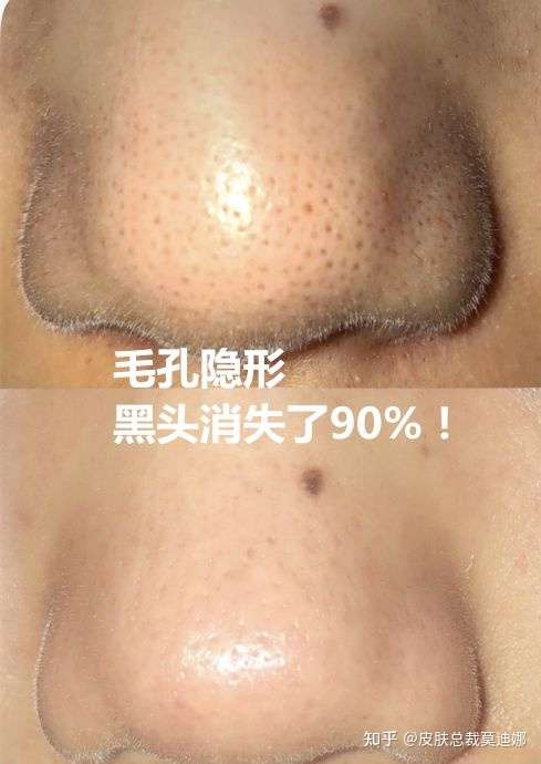 鼻头有黑头粉刺闭口油脂粒,眉心和鼻头毛孔粗大爱出油怎么办?