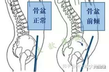 有问有答3产后骨盆前倾的运动矫正