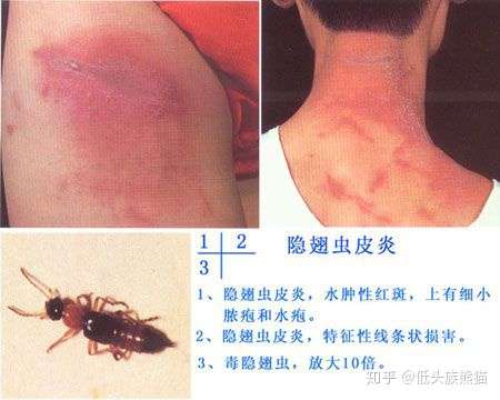 夹了一下子,肿了,很疼,这个有毒吗,整个手臂都不舒服?