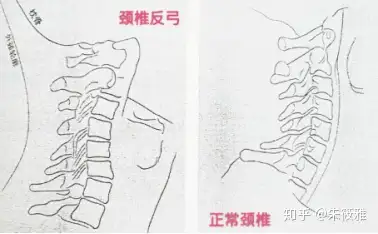 脊柱側彎常見問題頸椎反弓怎麼辦