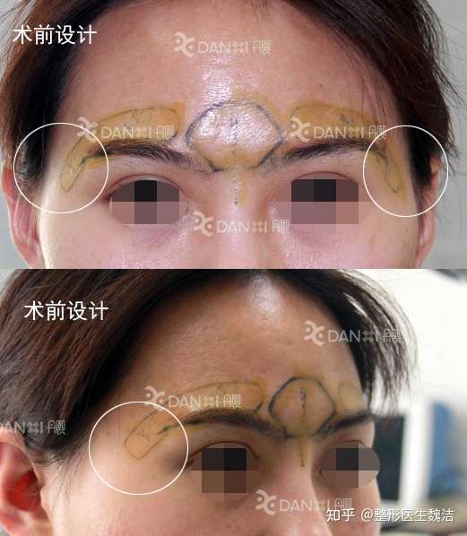 脂肪丰眉心联合假体丰眉弓手术改善衔接不自然 知乎