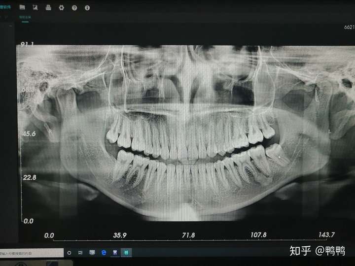 整齐的牙齿标准ct图片