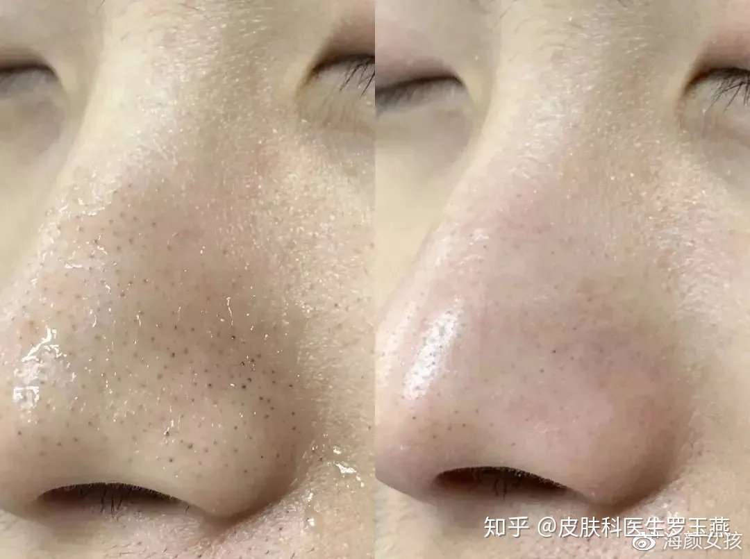 草莓鼻和酒糟鼻的区别在哪里 用点阵激光治疗好还是微针 知乎 草莓鼻和酒糟鼻的区别在哪里 用点阵激光治疗好还是微针 知乎