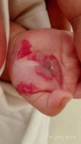 初生婴儿红色胎记图片