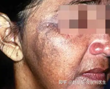 毁誉参半的美白神药——氢醌