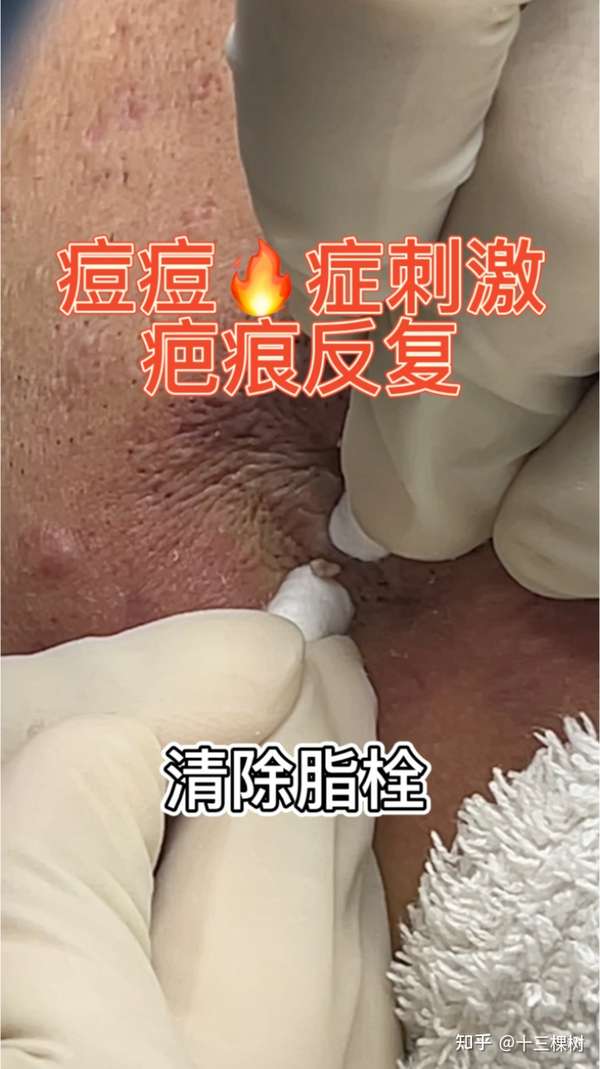 脂肪栓 硬化图片