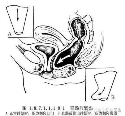 难以启齿,她每次排便需要把手伸入阴道,医生说这是病得治 - 知乎