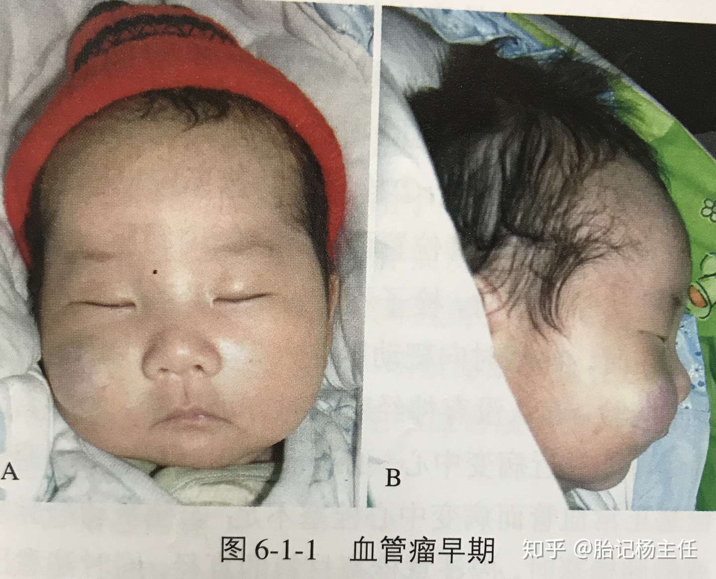 婴幼儿血管瘤自然发展史 知乎