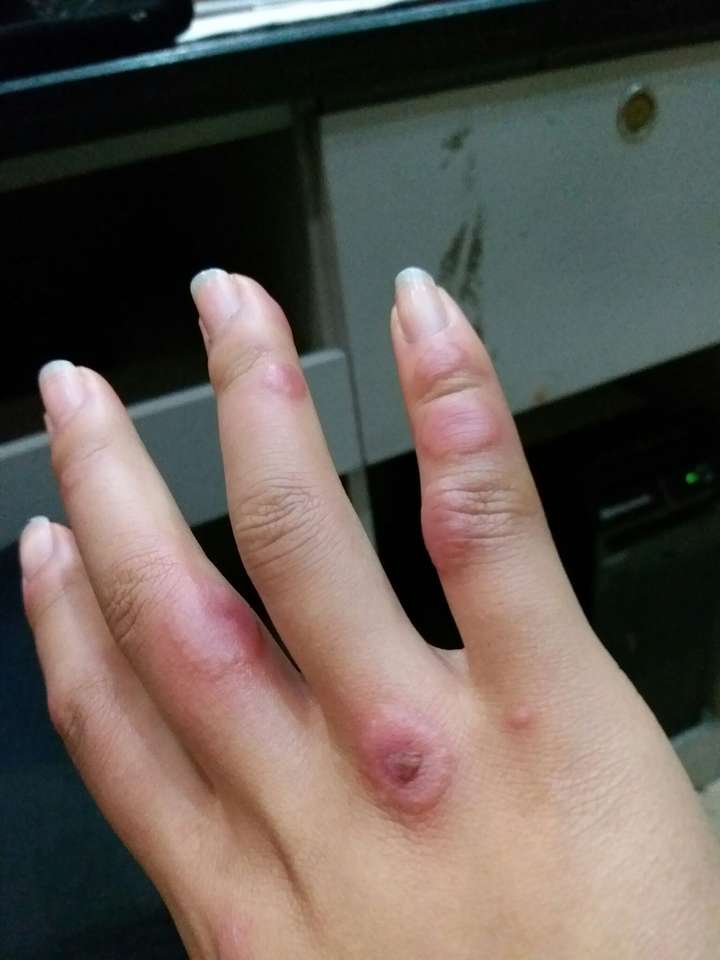 长冻疮是一种什么体验?为什么有的人从来都没长过?