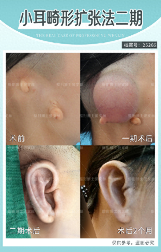 为什么余文林博士做耳再造尽量不植皮?