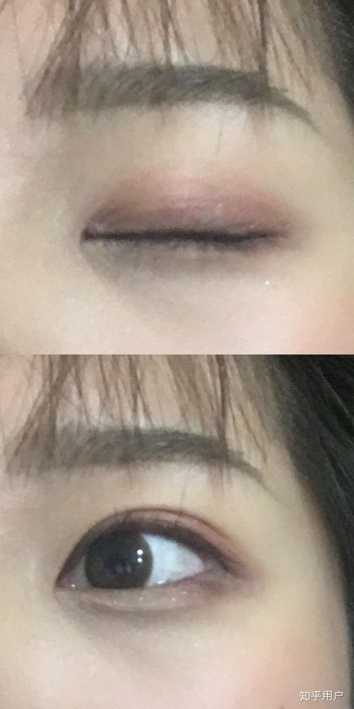 贴双眼皮贴很久的人最后都怎么样了?