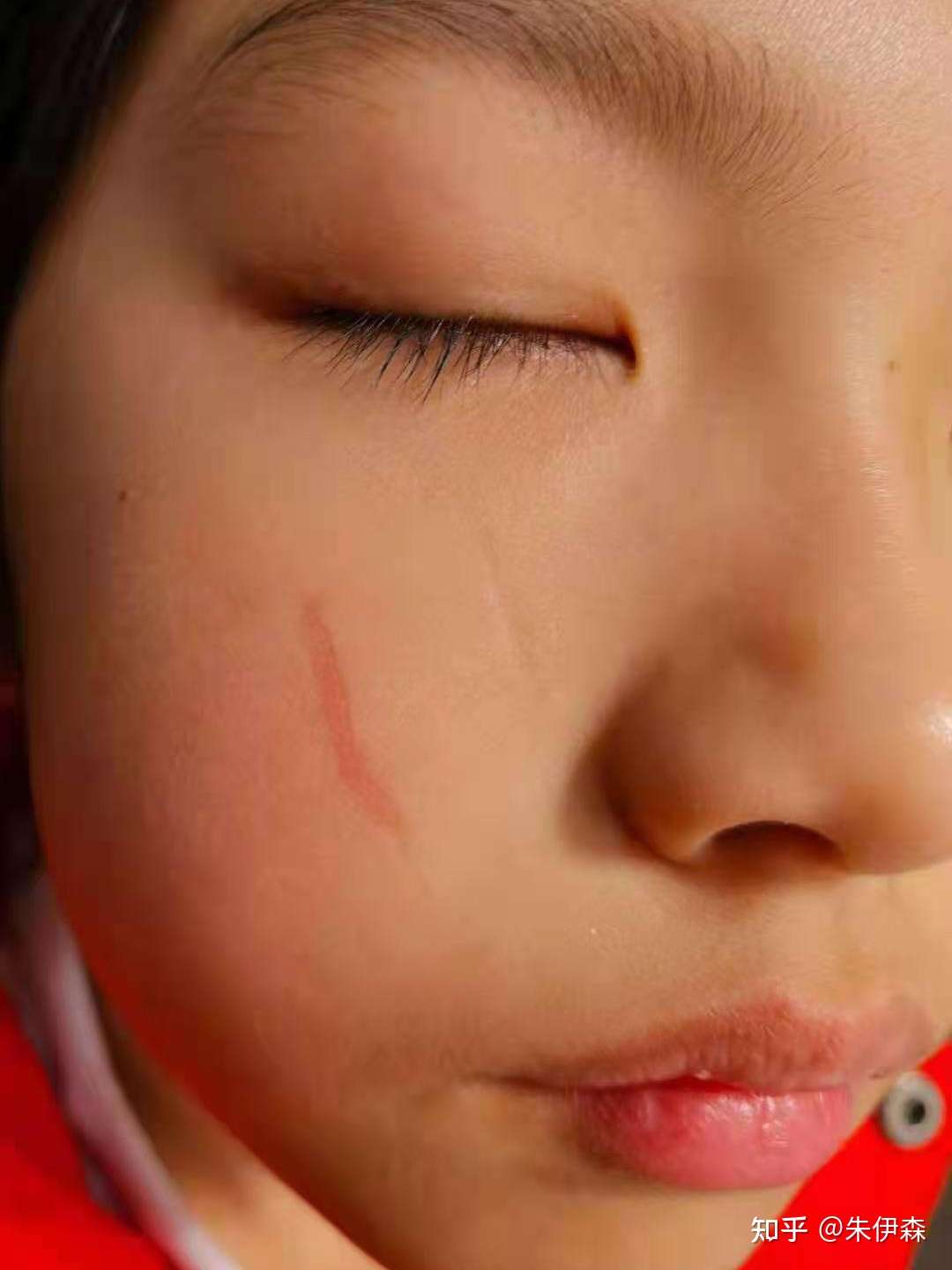 伤痕没有护理好 色素沉淀怎么办 知乎