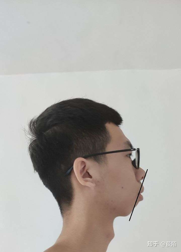 我这种突嘴下巴后缩能正颌吗