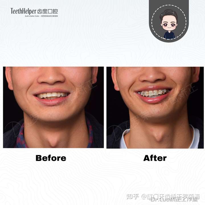 正畸治疗能缩短疗程吗?