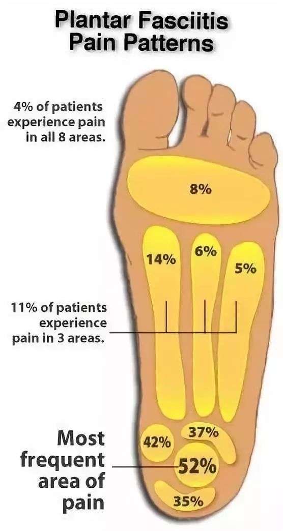 足底筋膜炎 像踩着钉子一样 4个动作帮你缓解 知乎