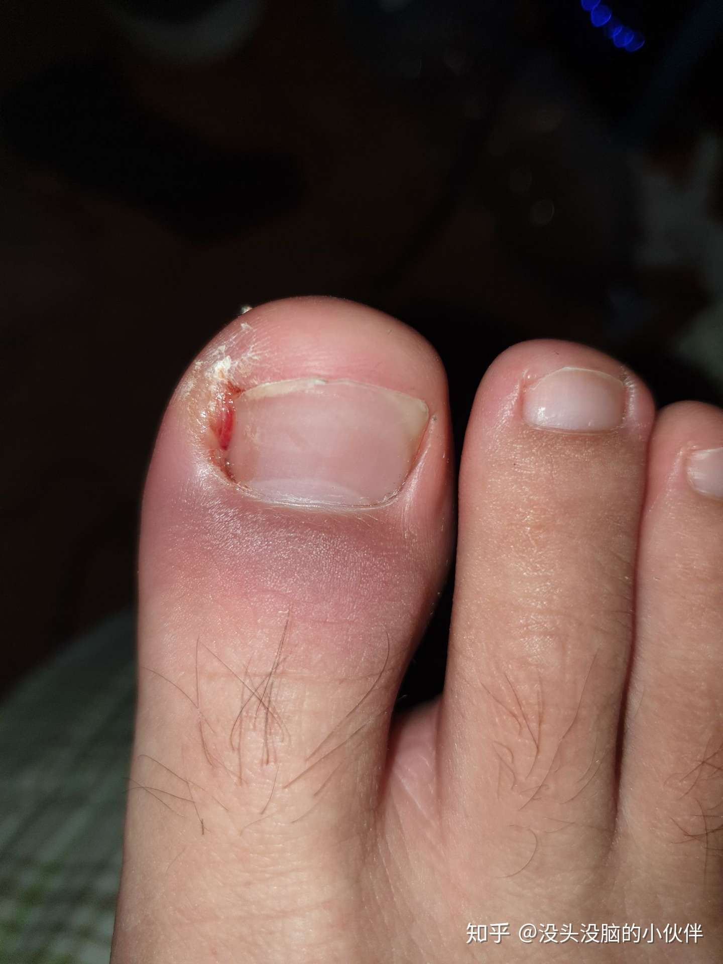 6种与痛风易混淆的病症 知乎