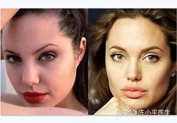 比如寡姐斯嘉丽·约翰逊,和以前相比,她的鼻子是明显发生了改变的.