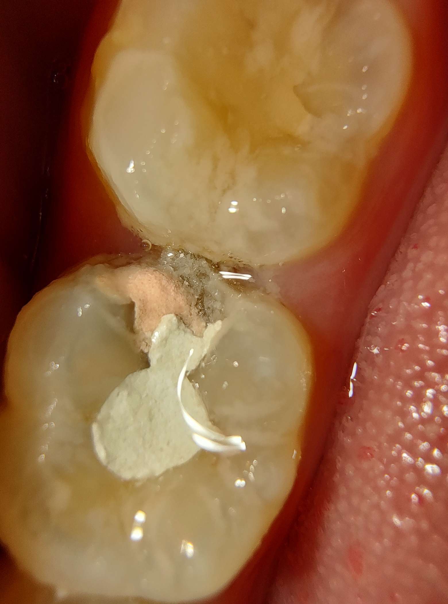 汪心亘 的想法: 1牙科根管治疗(不确定),杀神经,封药… - 知乎