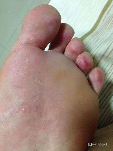 水疱型脚气水泡能扎破吗